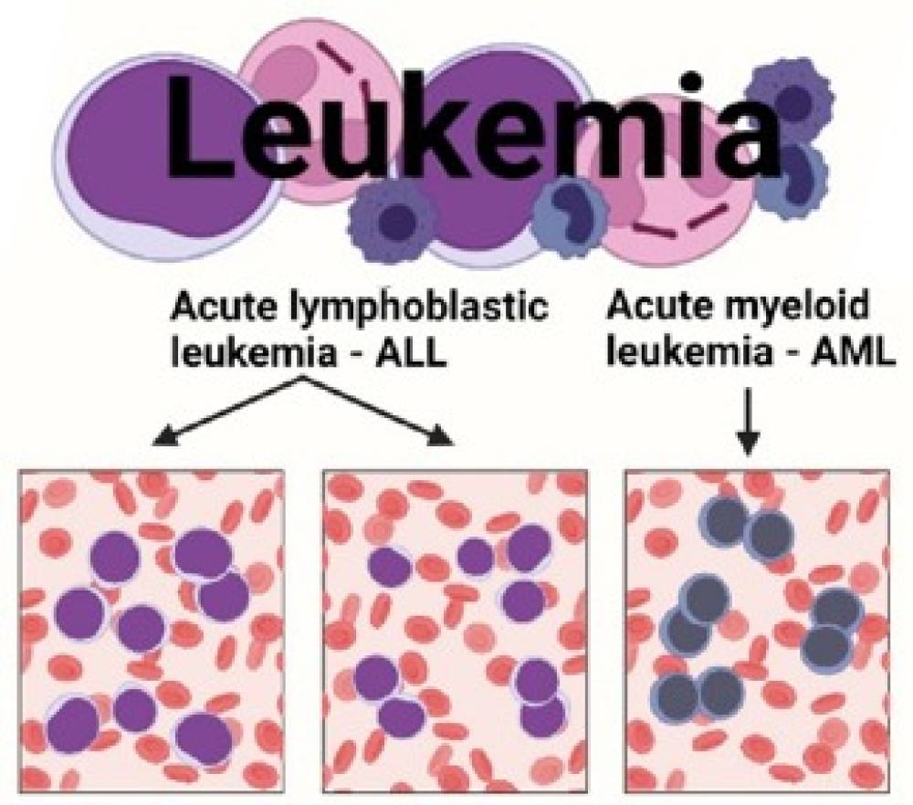 Acute Leukemia Panel